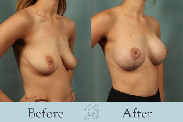 Breast Augmentation and Lift Before and After 20 _ Side