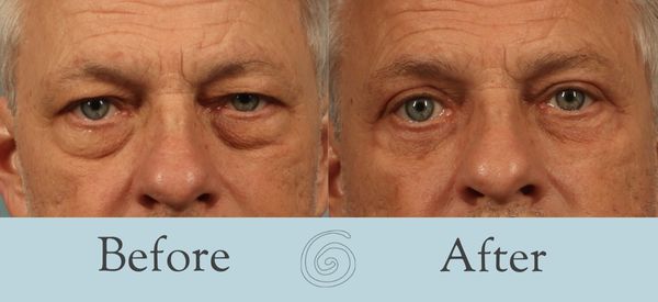Eyelid Surgery Before and After 28 - Front