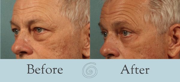 Eyelid Surgery Before and After 28 - Side