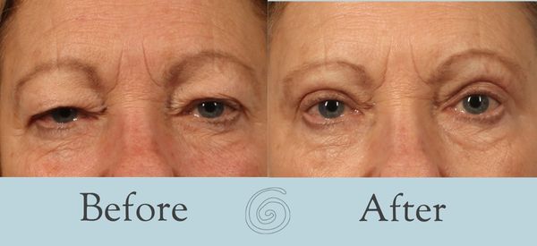 Eyelid Surgery Before and After 29 - Front