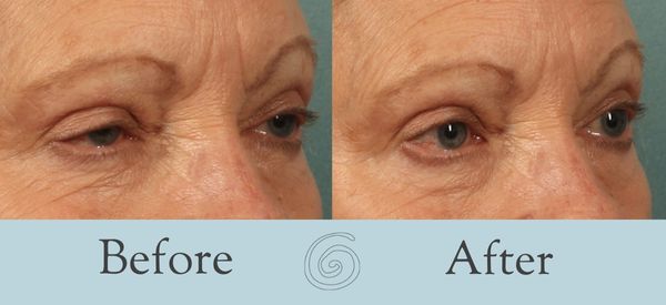 Eyelid Surgery Before and After 29 - Side