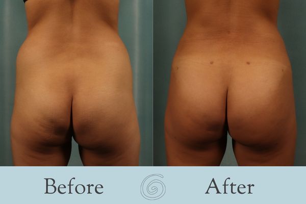 Brazilian Butt Lift - BBL Before and After 1 - Front