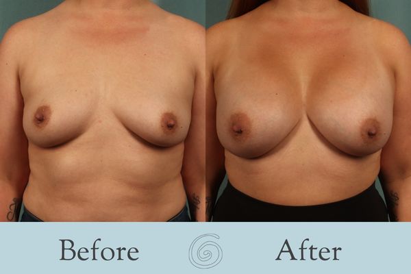 Breast Augmentation Before and After 31 - Front