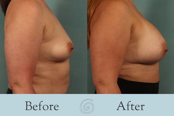 Breast Augmentation Before and After 31 - Side