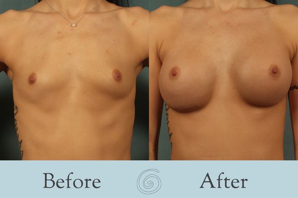 Breast Augmentation Before and After 32 - Front