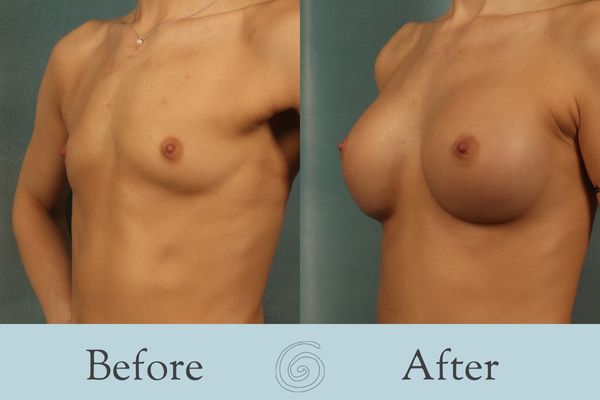 Breast Augmentation Before and After 32 - Side