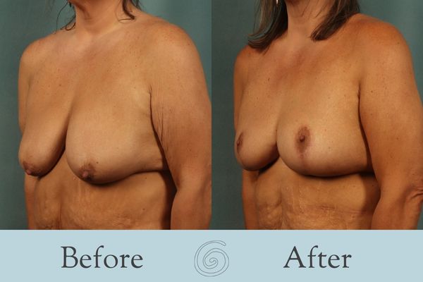 Breast Augmentation and Lift Before and After 21 _ Front