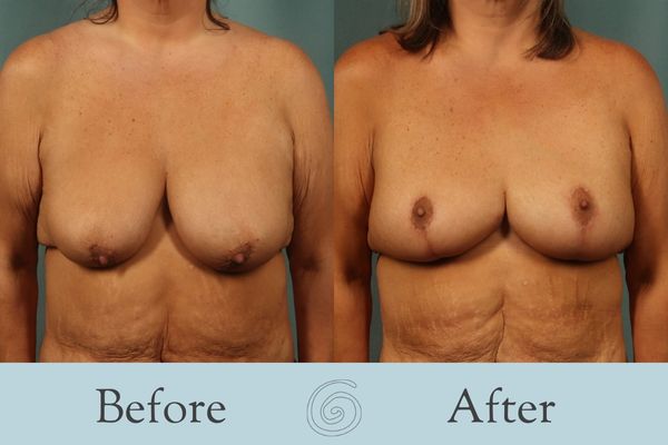 Breast Augmentation and Lift Before and After 21 _ Side
