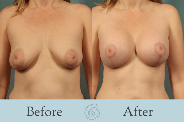 Breast Augmentation and Lift Before and After 22 _ Front