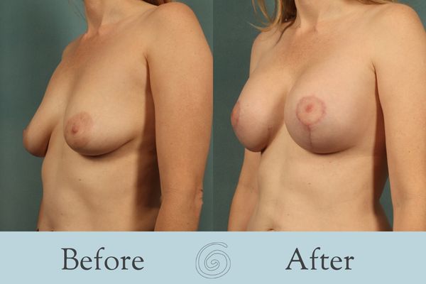 Breast Augmentation and Lift Before and After 22 _ Side