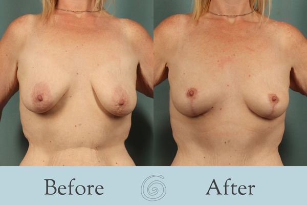 Breast Lift Before and After 9 - Front
