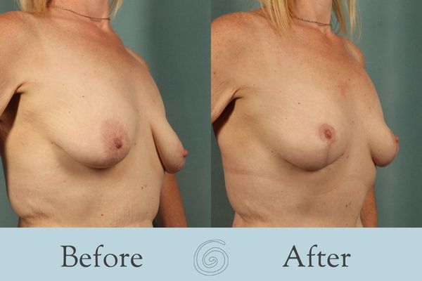 Breast Lift Before and After 9 - Side