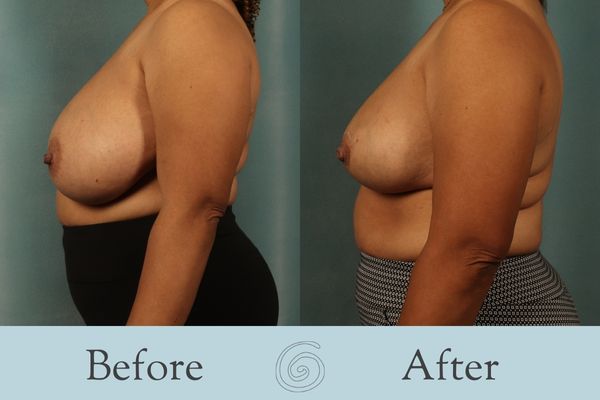 Breast Reduction Before and After 24 - Side