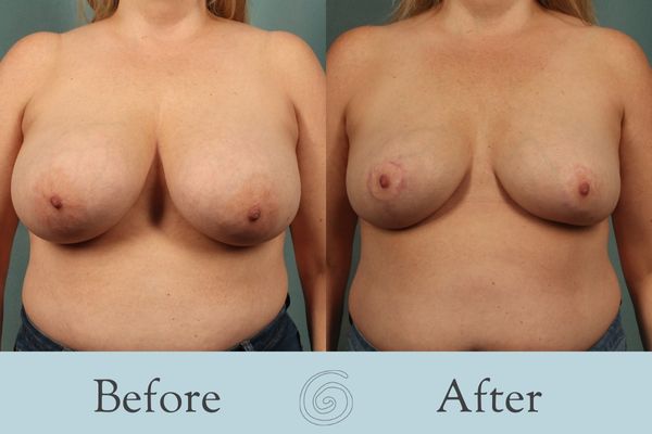 Breast Reduction Before and After 25 - Front