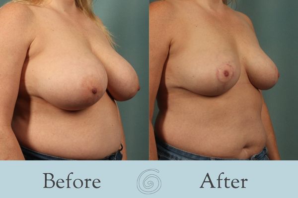 Breast Reduction Before and After 25 - Side