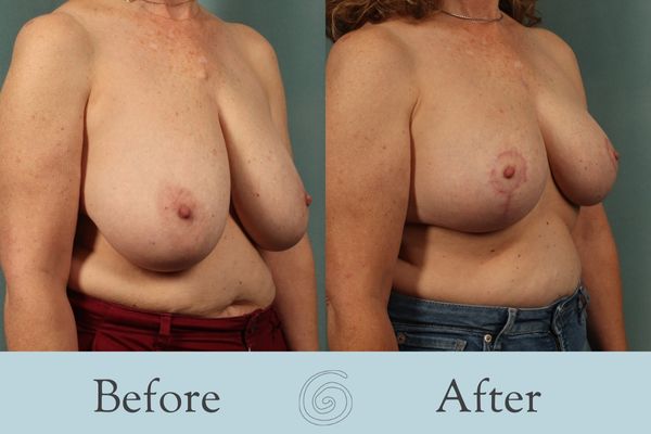 Breast Reduction Before and After 26 - Side