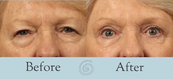 Eyelid Surgery Before and After 30 - Front