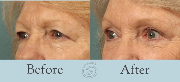 Eyelid Surgery Before and After 30 - Side