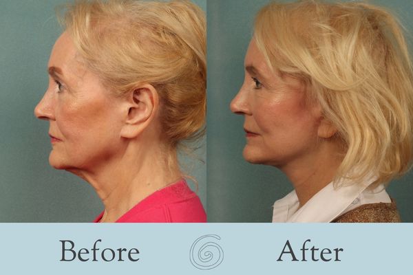 Facelift Before and After 15 - Side