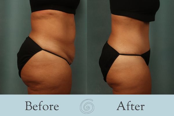 Tummy Tuck Before and After 30 - Front