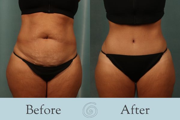Tummy Tuck Before and After 30 - Side