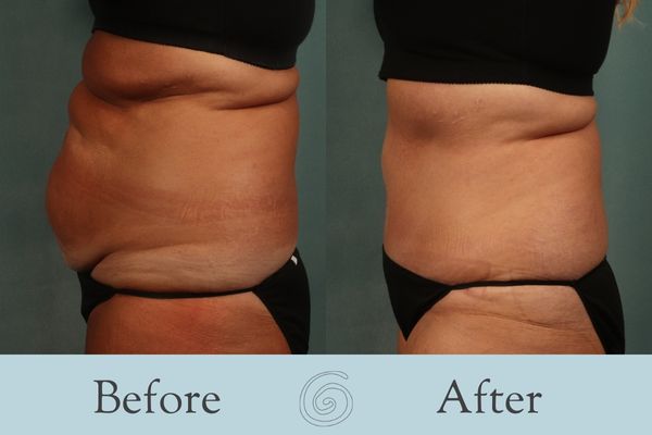 Tummy Tuck Before and After 31 - Side