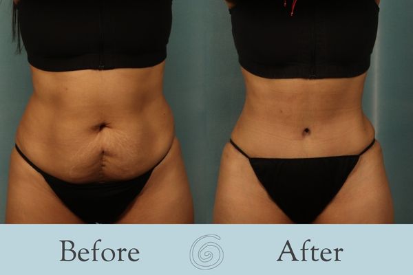 Tummy Tuck Before and After 33 - Front