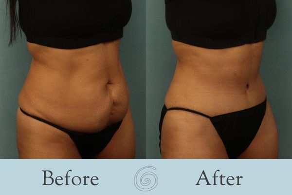 Tummy Tuck Before and After 33 - Side