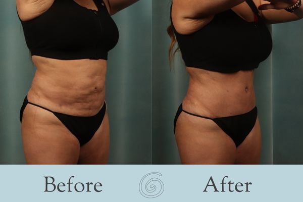 Tummy Tuck Before and After 34 - Side