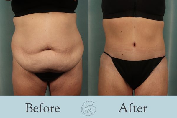 Tummy Tuck Before and After 35 - Front