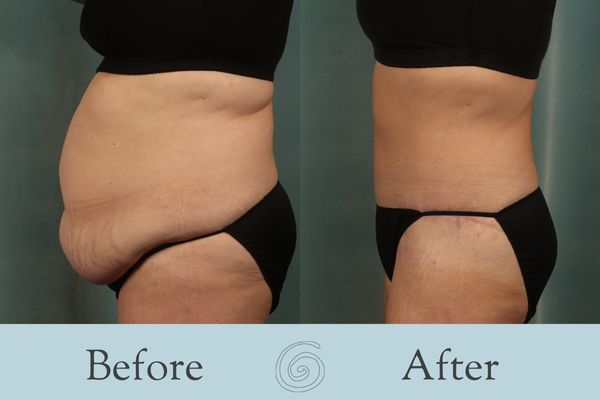 Tummy Tuck Before and After 35 - Side
