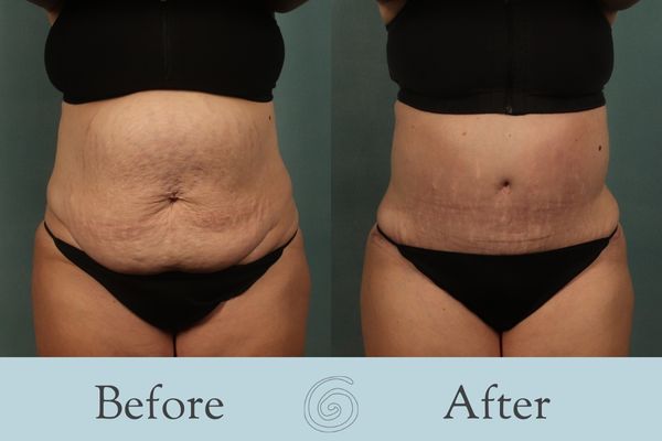 Tummy Tuck Before and After 36 - Front