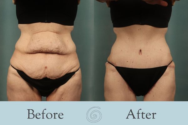 Tummy Tuck Before and After 37 - Front