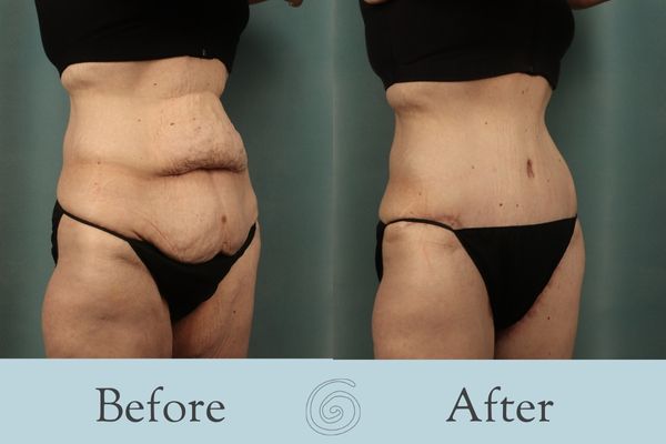 Tummy Tuck Before and After 37 - Side