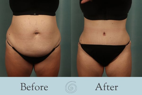 Tummy Tuck Before and After 38 - Front