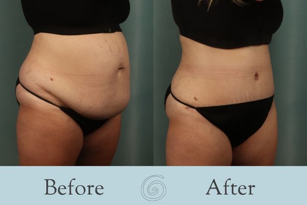 Tummy Tuck Before and After 38 - Side