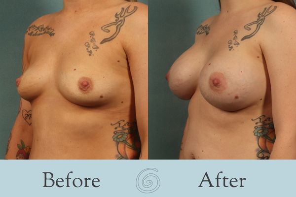 Breast Augmentation Before and After 33 - Side