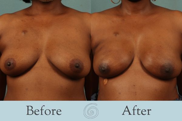 Breast Reconstruction Before and After 1 - Front