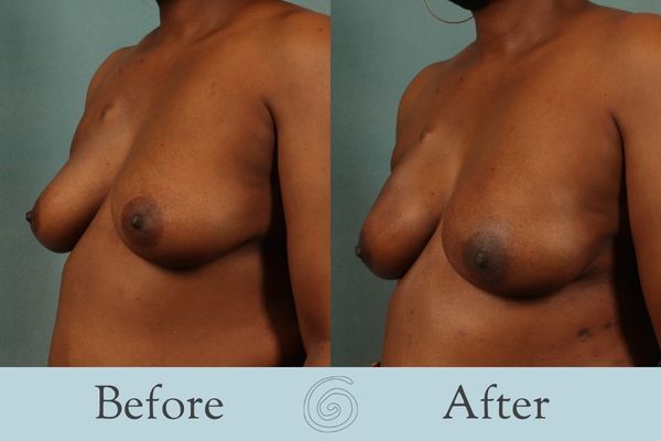 Breast Reconstruction Before and After 1 - Side