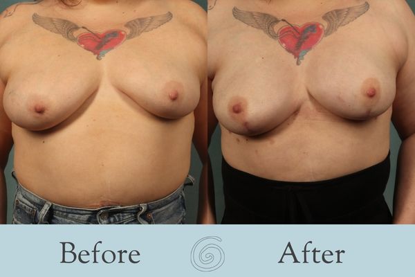 Breast Reconstruction Before and After 2 - Front