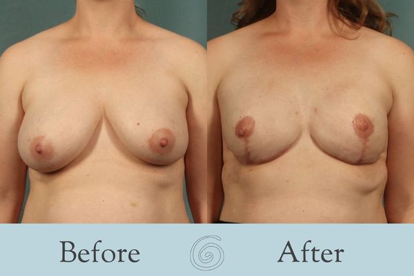 Breast Reconstruction Before and After 3 - Front
