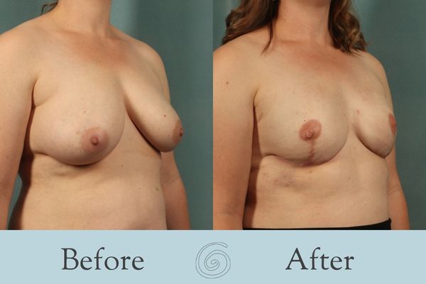 Breast Reconstruction Before and After 3 - Side