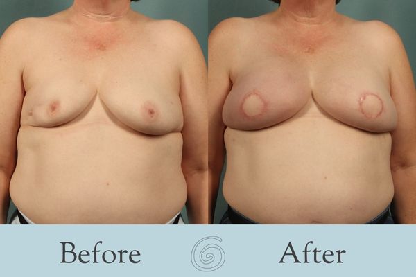 Breast Reconstruction Before and After 4 - Front