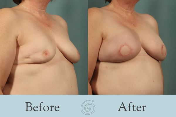 Breast Reconstruction Before and After 4 - Side
