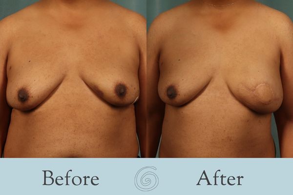 Breast Reconstruction Before and After 5 - Front