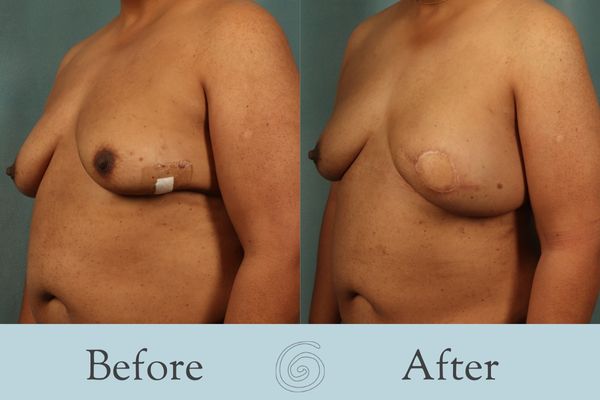 Breast Reconstruction Before and After 5 - Side