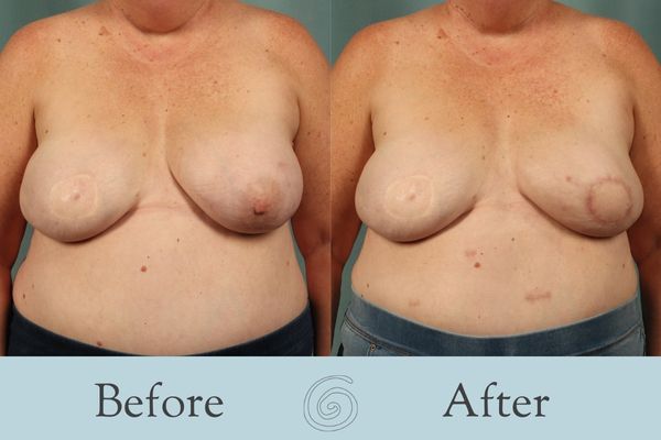 Breast Reconstruction Before and After 6 - Front