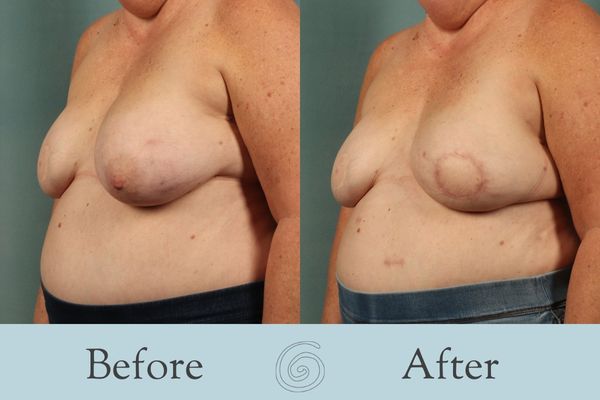 Breast Reconstruction Before and After 6 - Side