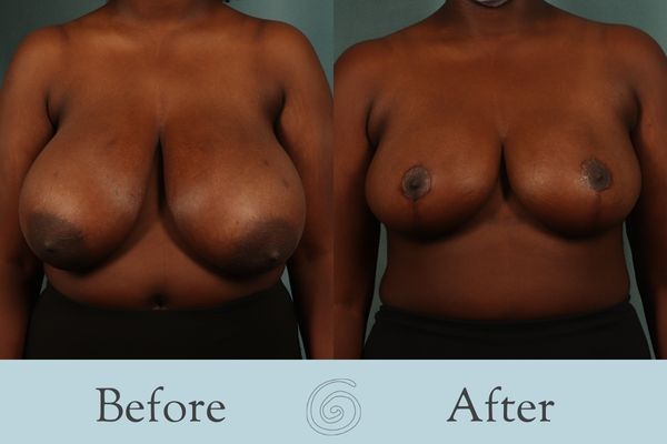 Breast Reduction Before and After 27 - Front