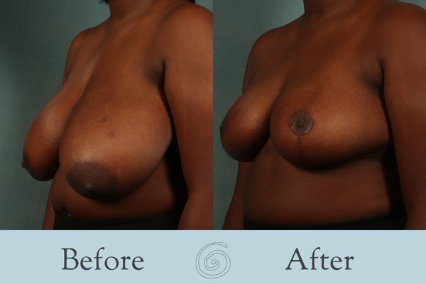 Breast Reduction Before and After 27 - Side